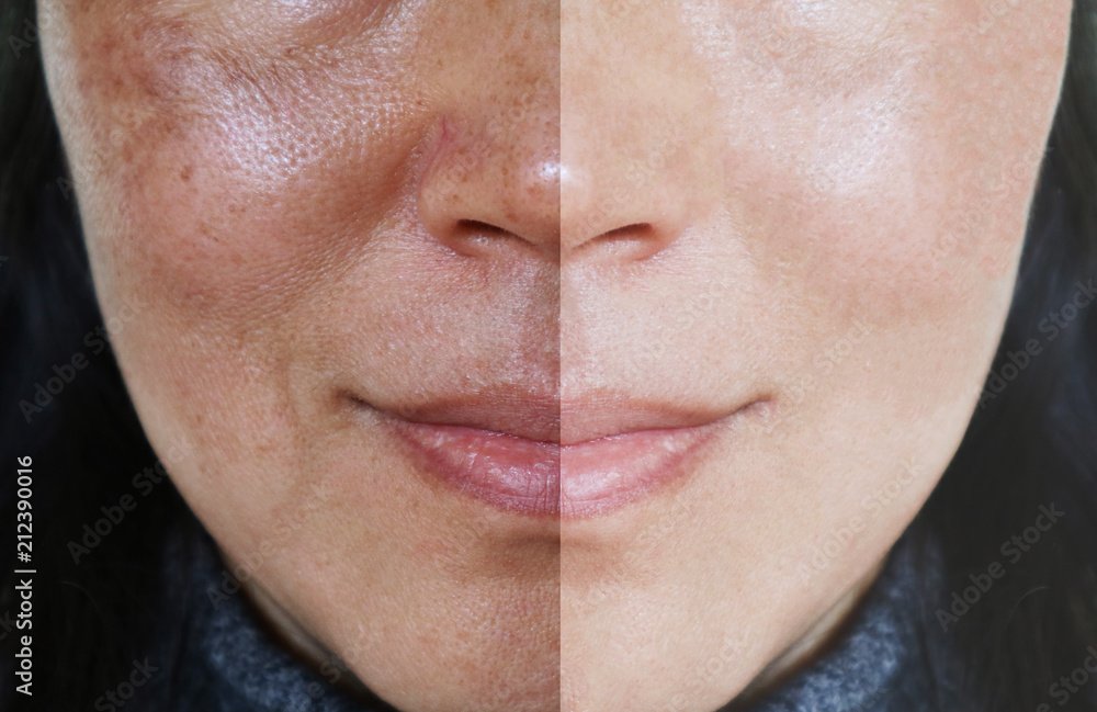 Melasma treatment for clear and even skin tone at DAG Dental & Aesthetics