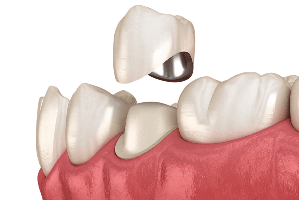 Metal dental crown placed on a tooth, shiny silver restoration