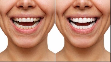 Natural-looking dental veneers on healthy teeth for a bright smile in Lahore