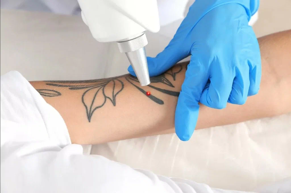 Laser tattoo removal treatment at DAG Dental & Aesthetics in DHA Lahore