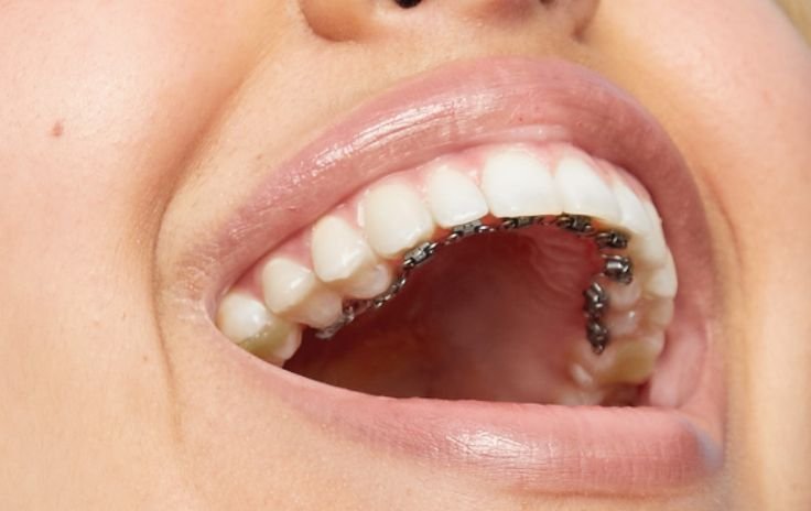 Orthodontic Treatments for Straightening Crooked and Misaligned Teeth