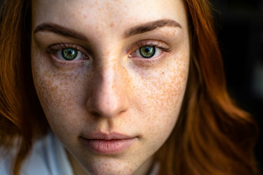 Melasma treatment showing reduction of dark facial pigmentation