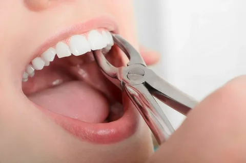 Safe tooth extraction procedure at dental clinic in Lahore performed by professional dentist