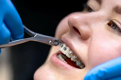 Orthodontic Treatments for Straightening Crooked and Misaligned Teeth
