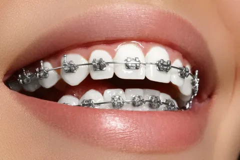 Orthodontic Treatments for Straightening Crooked and Misaligned Teeth