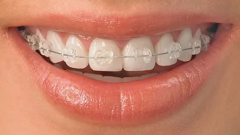 Orthodontic Treatments for Straightening Crooked and Misaligned Teeth