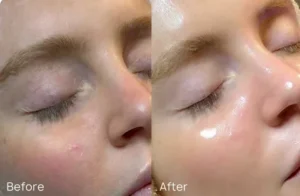 HydraFacial Treatment Before and After Results | Clear & Glowing Skin Transformation