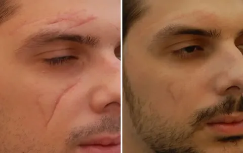 Mole Removal Treatment for Safe Skin Lesion Removal and Clear Skin